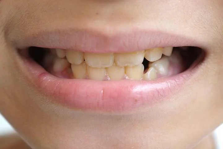 دلایل زرد شدن دندان ها