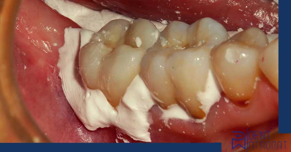 سمان زینک فسفات هافمن (Hoffman)