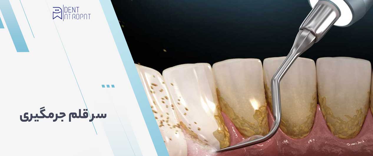 سر قلم جرمگیری