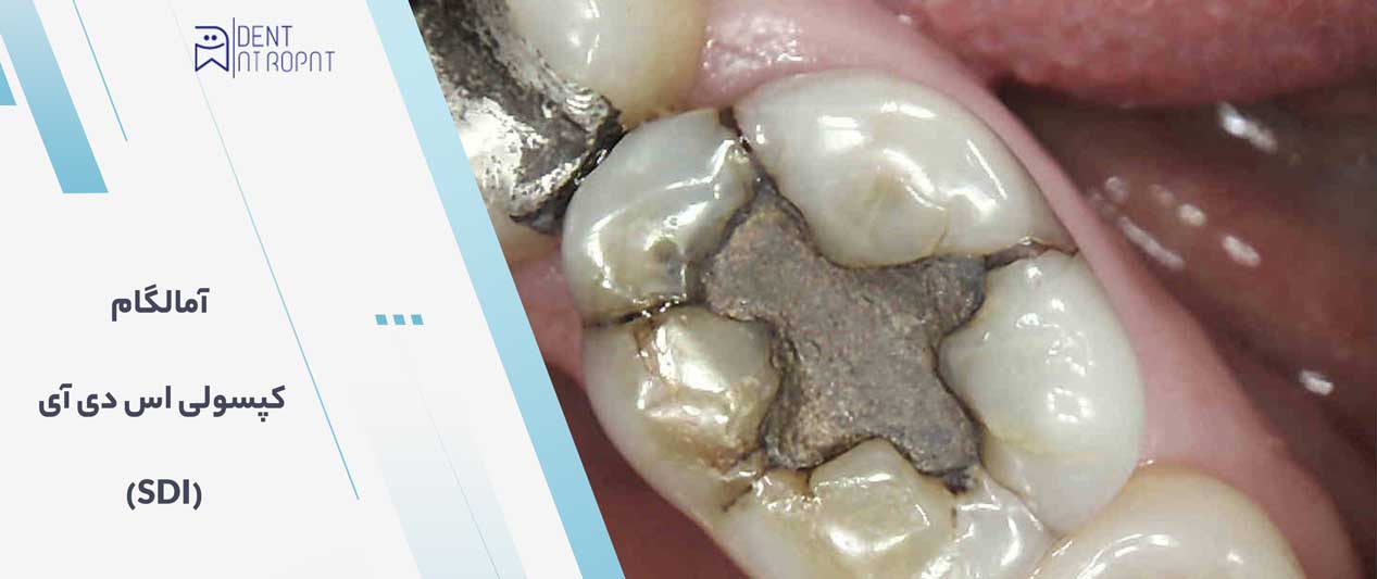 آمالگام کپسولی اس دی آی (SDI) 1 تجهیزات دندانپزشکی دنت آتروپات