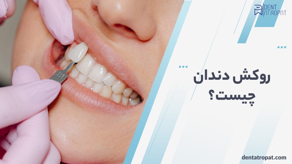 روکش دندان چیست ؟