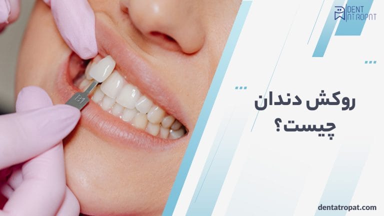 روکش دندان چیست ؟