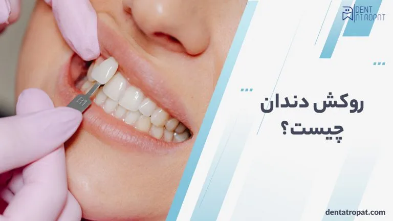 روکش دندان چیست ؟