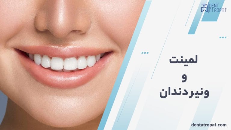 لمینت و ونیر دندان : مزایا، معایب و تفاوت‌ ها